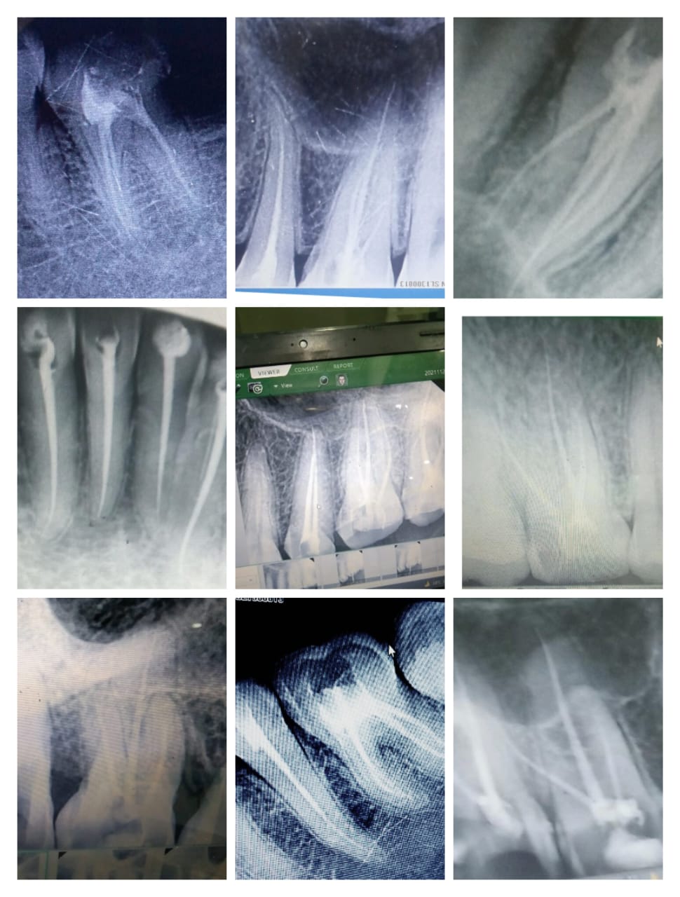 Before Treatment